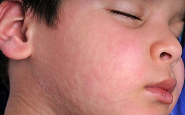 Allergische Hautausschläge - ein Symptom für das Vorhandensein parasitärer Würmer im Körper