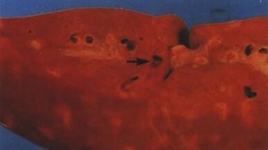 welche Parasiten in der menschlichen Leber leben können